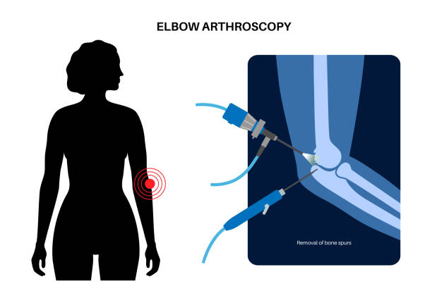 Arthroscopy ምንድን ነው?
