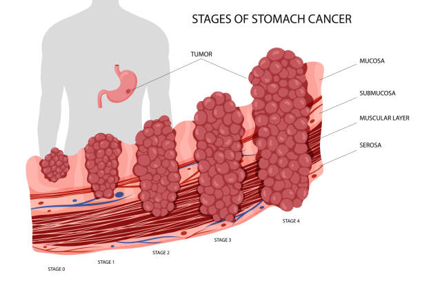 Κατανόηση της εξέλιξης από τις προκαρκινικές αλλοιώσεις στον καρκίνο