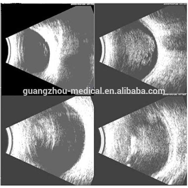 Portativ AB skaneri: Oftalmik ultratovush tasviri